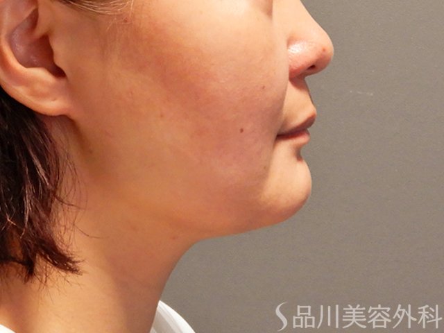 症例NO.70314のAFTER写真