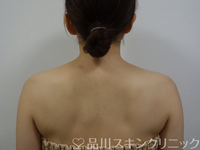 症例NO.74210のBEFORE写真