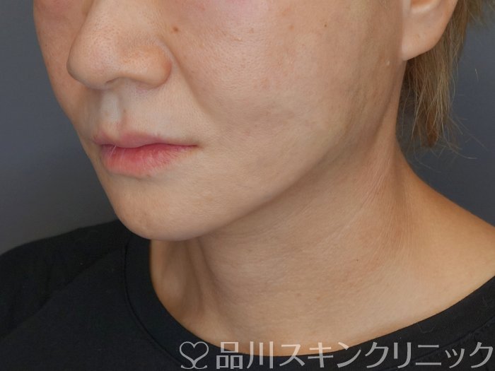 症例NO.71821のAFTER写真