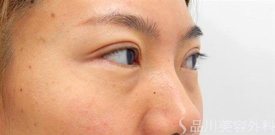 症例NO.53420のBEFORE写真