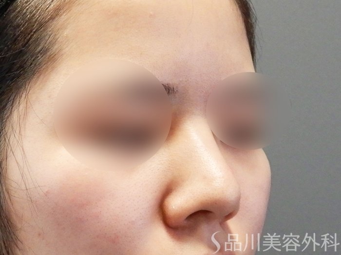 症例NO.71066のBEFORE写真