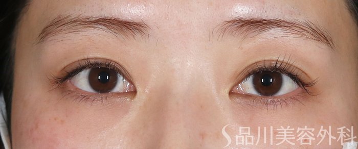 症例NO.72849のBEFORE写真