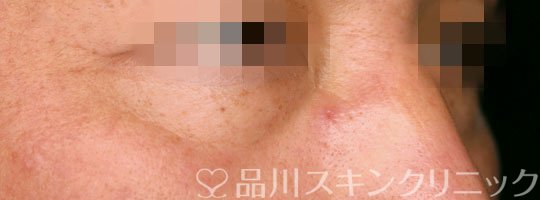 症例NO.70556のBEFORE写真