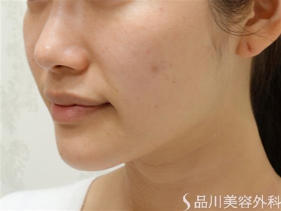 症例NO.47375のBEFORE写真