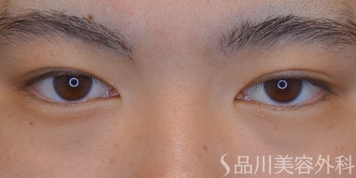 症例NO.73908のAFTER写真