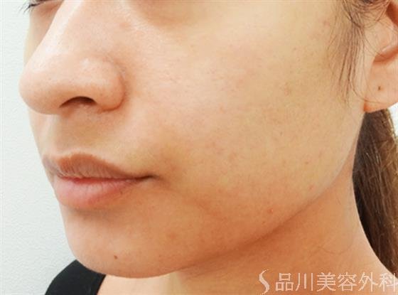 症例NO.33420のAFTER写真