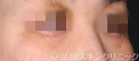 症例NO.71307のBEFORE写真