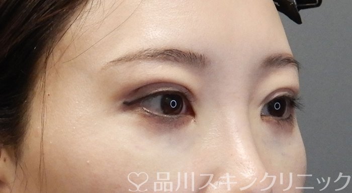 症例NO.72190のAFTER写真