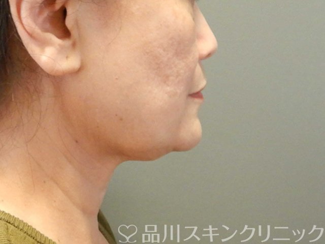 症例NO.66542のBEFORE写真