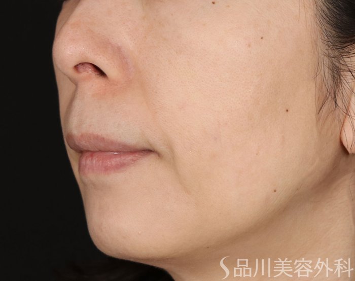 症例NO.71932のBEFORE写真