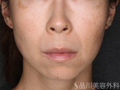 症例NO.73887のBEFORE写真