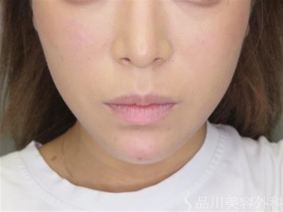 症例NO.48180のAFTER写真
