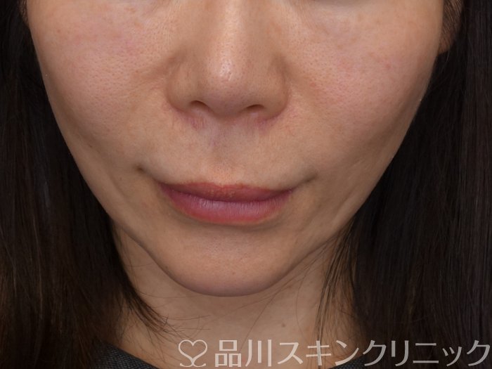 症例NO.74156のBEFORE写真