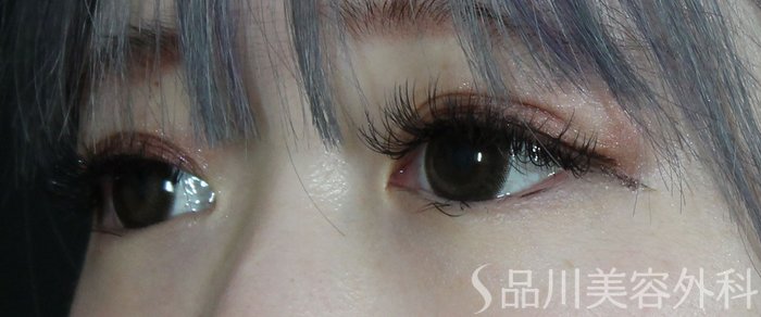 症例NO.73391のBEFORE写真