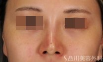 症例NO.71699のAFTER写真
