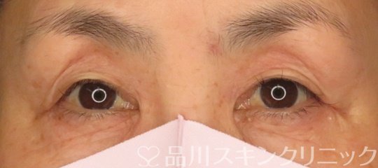 症例NO.71061のBEFORE写真