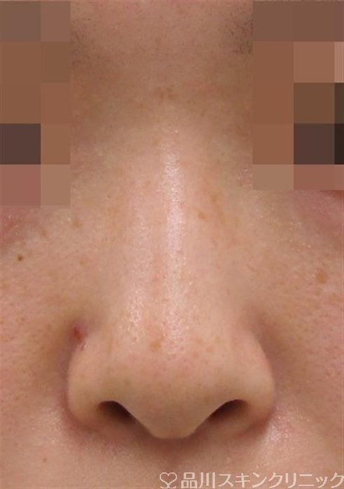 症例NO.38833のBEFORE写真