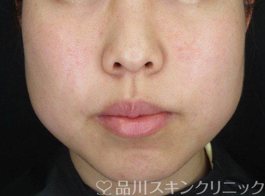 症例NO.70309のBEFORE写真