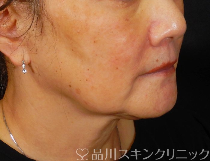 症例NO.67390のBEFORE写真