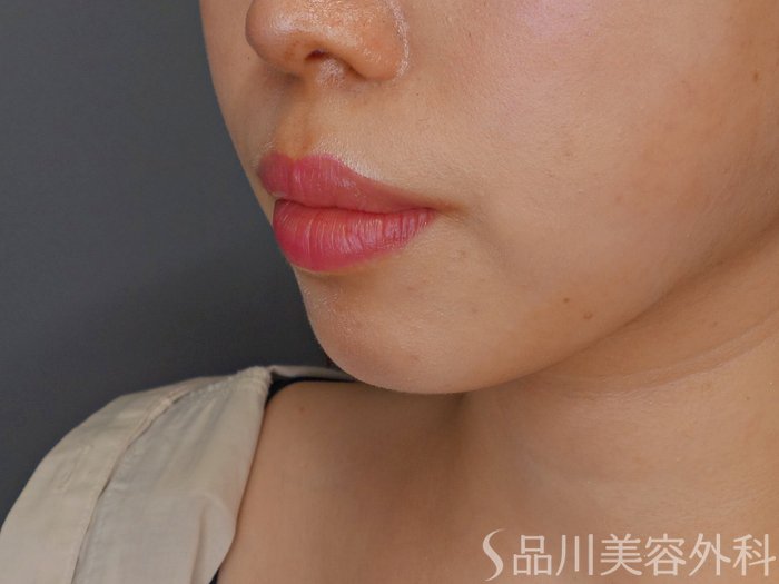 症例NO.62439のBEFORE写真