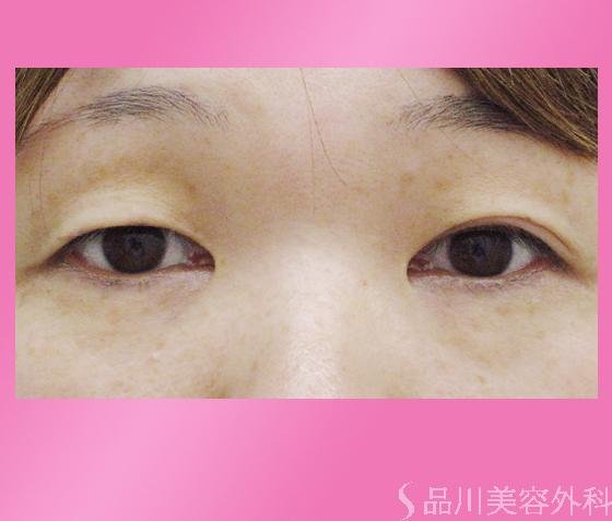 症例NO.1125のBEFORE写真