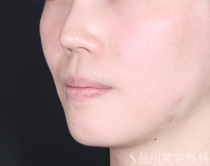 症例NO.72797のAFTER写真