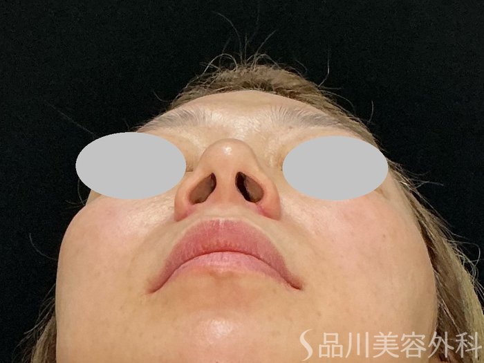 症例NO.73183のAFTER写真