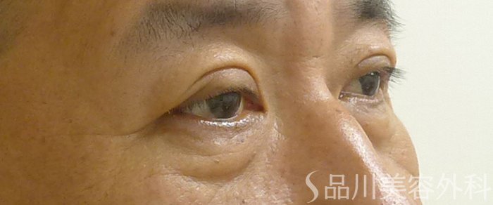 症例NO.72159のAFTER写真