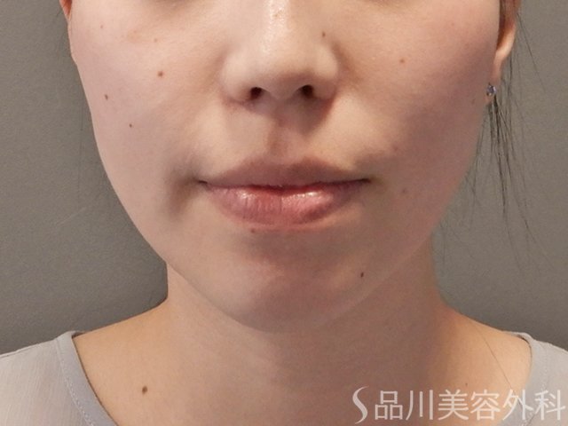 症例NO.75130のBEFORE写真