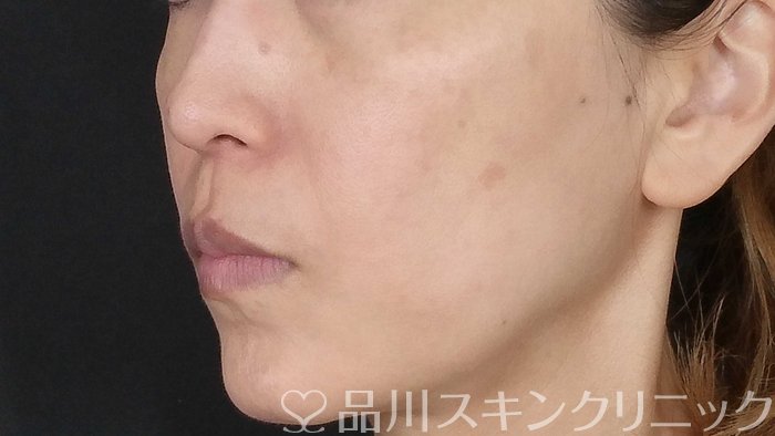 症例NO.71287のBEFORE写真
