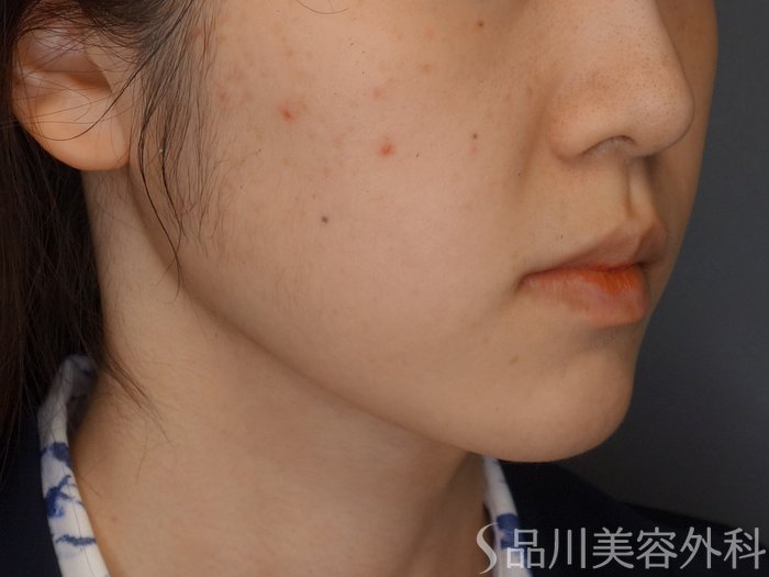 症例NO.71175のBEFORE写真