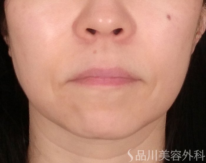 症例NO.70030のBEFORE写真