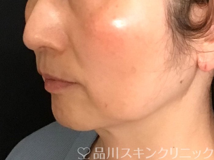 症例NO.65507のBEFORE写真