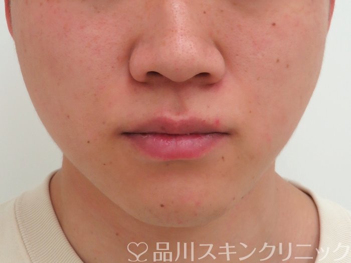 症例NO.65822のAFTER写真
