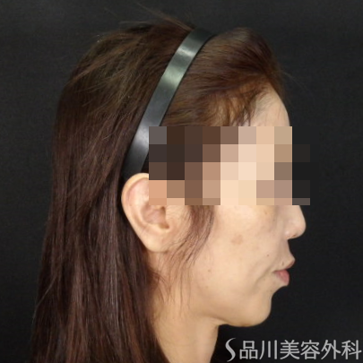 症例NO.73836のBEFORE写真