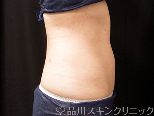 症例NO.69367のAFTER写真