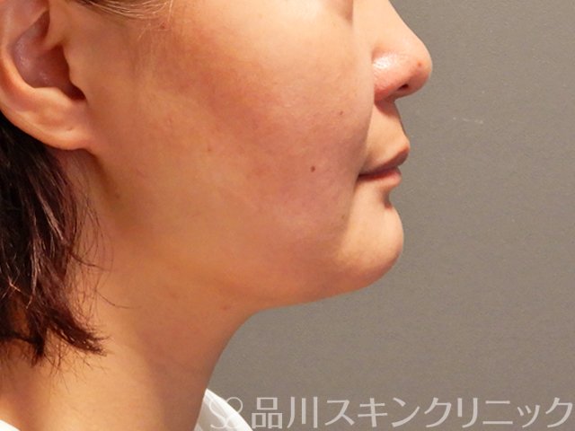 症例NO.70314のAFTER写真