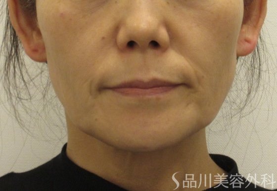 症例NO.72707のBEFORE写真