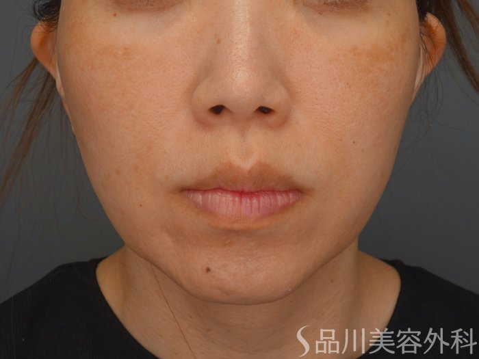症例NO.75289のBEFORE写真