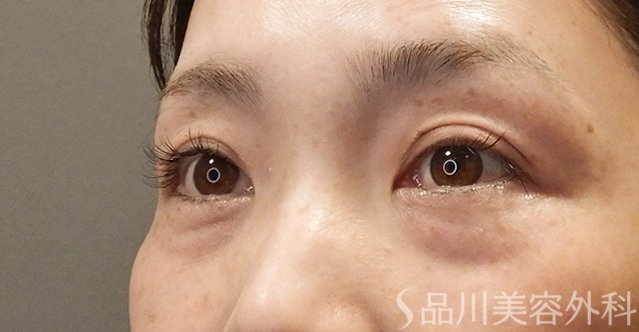 症例NO.74745のBEFORE写真