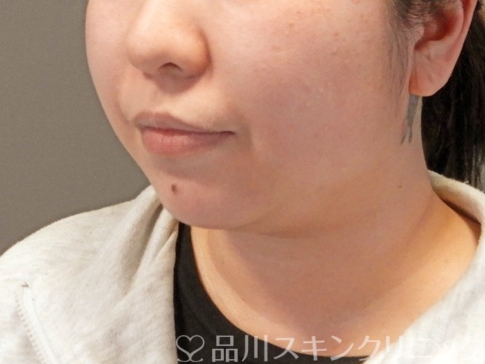 症例NO.64193のBEFORE写真