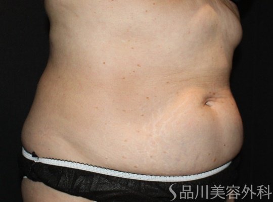 症例NO.74886のAFTER写真