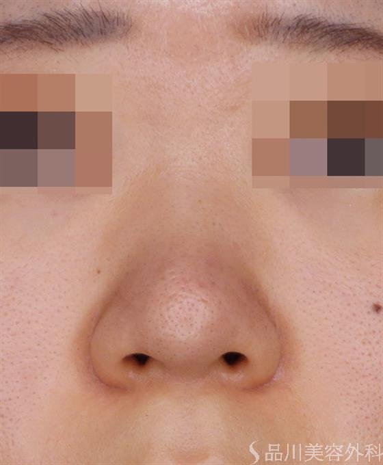 症例NO.49499のAFTER写真