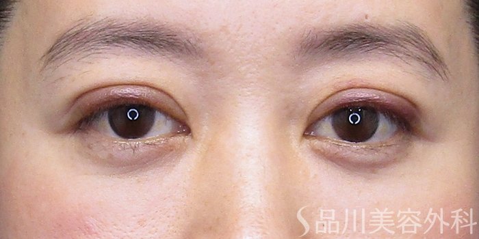 症例NO.75203のAFTER写真