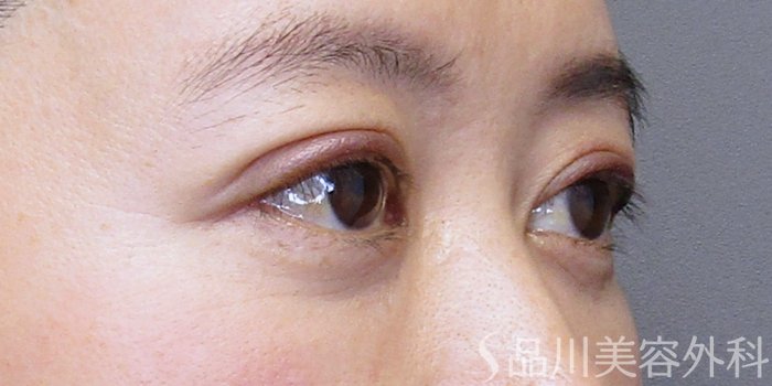 症例NO.75203のAFTER写真