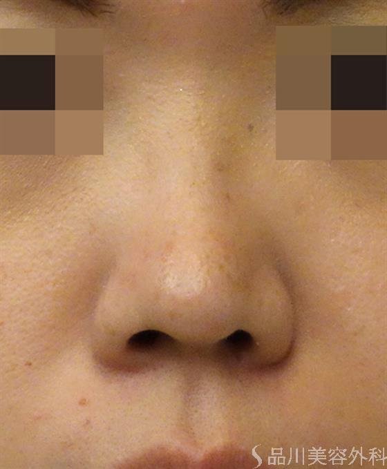 症例NO.40101のAFTER写真