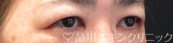 症例NO.70868のBEFORE写真