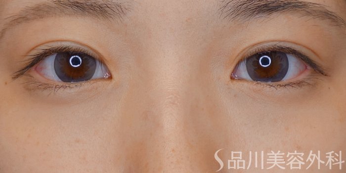 症例NO.71324のBEFORE写真