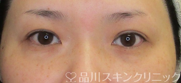 症例NO.69828のBEFORE写真
