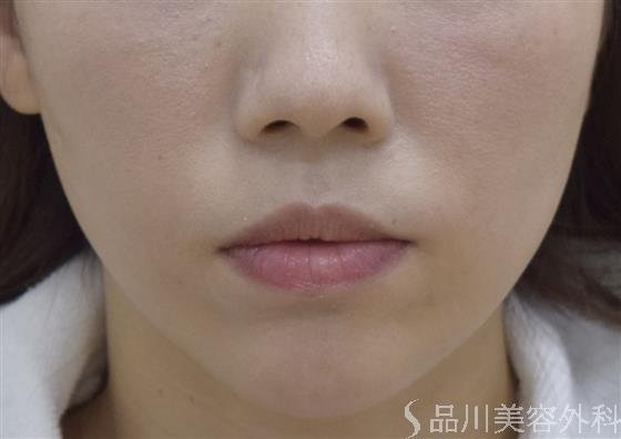 症例NO.47340のAFTER写真